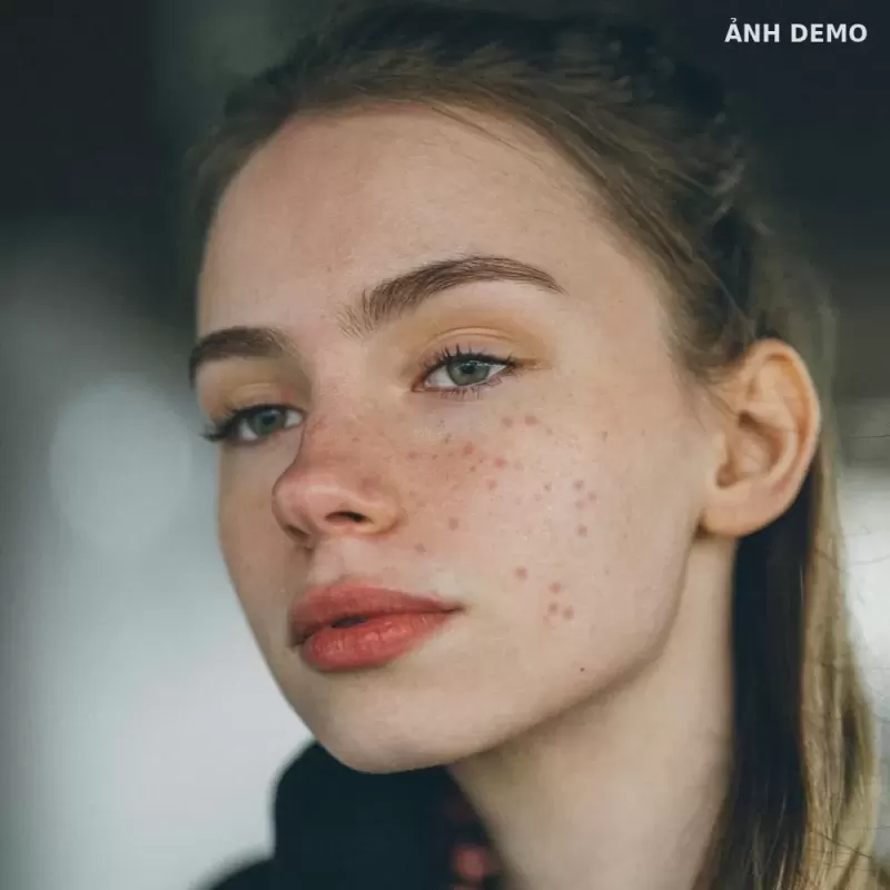 Trước điều trị — Mụn ẩn, da sần — phối hợp peel nông (ảnh minh hoạ demo)