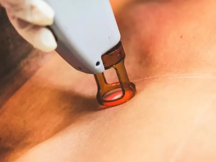Laser Picosecond trị tàn nhang, đốm nâu t?i ph?ng kh?m (?nh minh h?a)