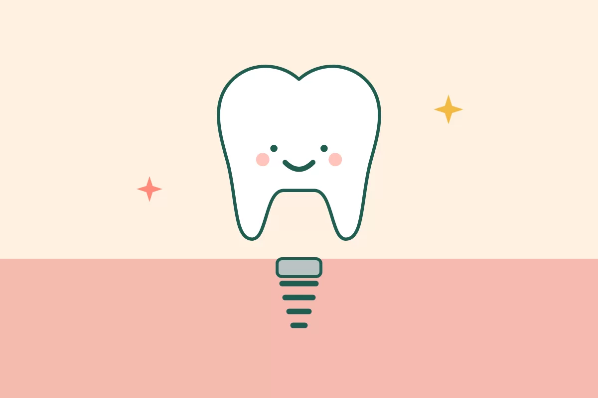 Minh hoạ chiếc răng trên trụ Implant cắm vào nướu hồng