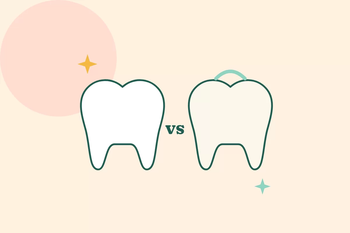 Minh hoạ hai chiếc răng đặt cạnh nhau với chữ vs, so sánh bọc sứ và veneer