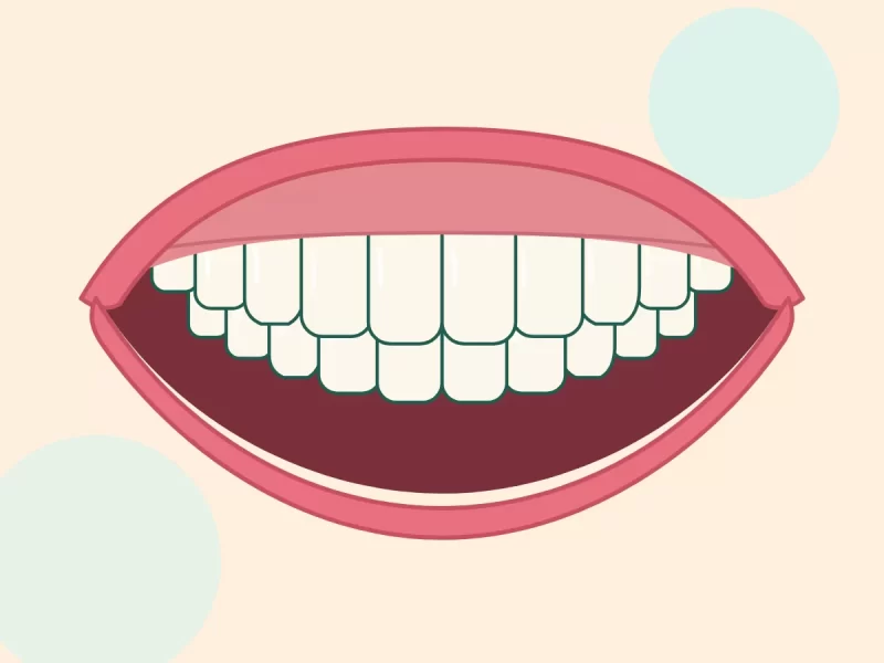 Hàm răng đầy đủ sau khi gắn răng sứ trên Implant (ảnh minh hoạ)