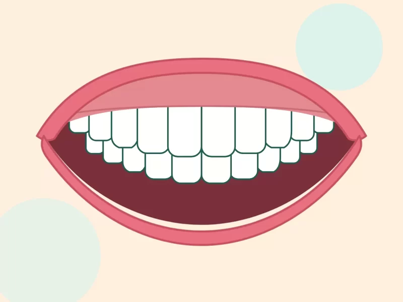 Răng cửa khít đều sau khi dán veneer (ảnh minh hoạ)